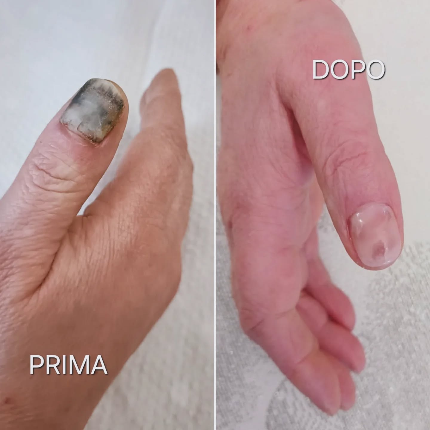 La nostra cliente ha chiesto aiuto alla nostra Anna

Nel prima possiamo vedere lunghia schiacciata che in seguito si è staccata
Nel dopo la nostra Anna ha rimosso lunghia e ricostruita con il gel su un tono naturale

La nostra cliente  è rimasta soddisfatta  super contenta

La nostra Anna risolve ogni problema
💅🏻 Cosa aspetti?
Scopri i nostri servizi e prenota il tuo appuntamento

httpswwwparrucchiere-estetistait

Tel 059926258

Via Francesco Bertelli 911 41013 Castelfranco Emilia Modena Emilia-Romagna Italia

pinknails nails nailsofinstagram nailart glitternails nailsoftheday acrylicnails gelnails longnails nailinspo nailsnailsnails nailtech pink explorepage nailsonfleek ombrenails naildesign shortnails naildesigns nudenails manicure naturalnails nailartist coffinnails instanails summernails nailstagram gelpolish nailsart frenchnails